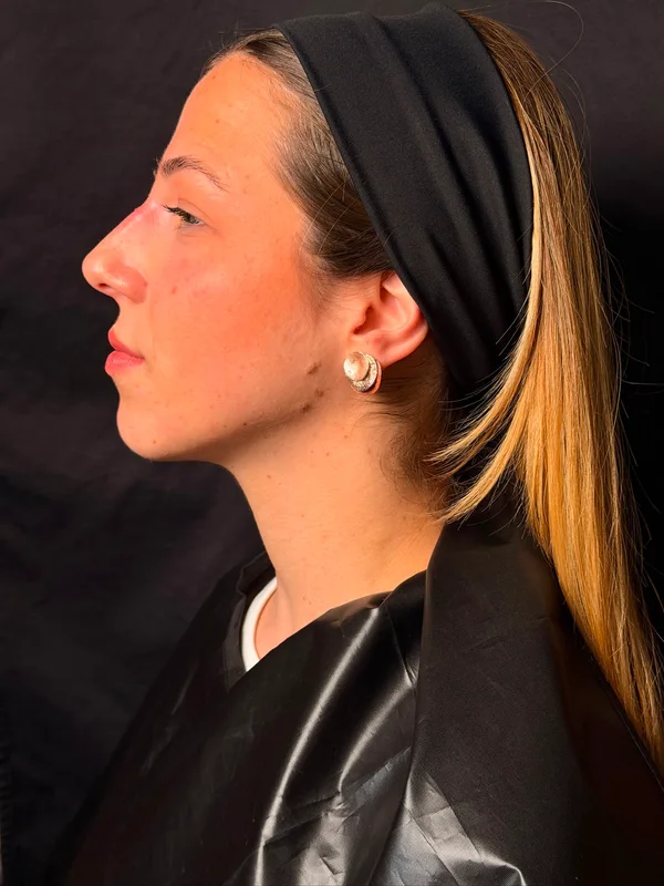 Rinofiller · Caso 2 · Dopo · fotografia dell’archivio Biodent